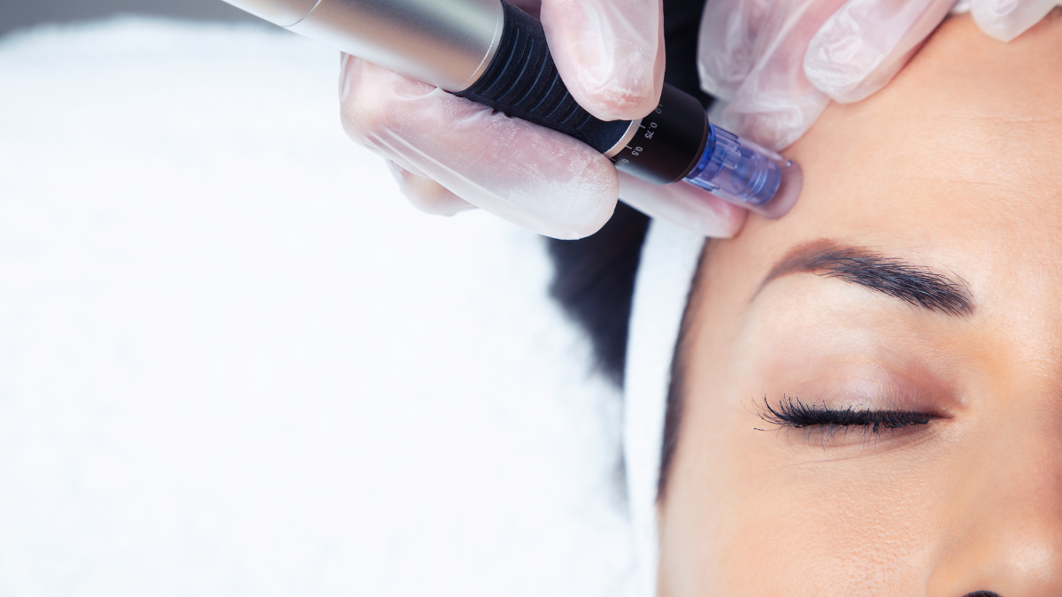The Best Benefits Of RF Microneedling For Your Skin.